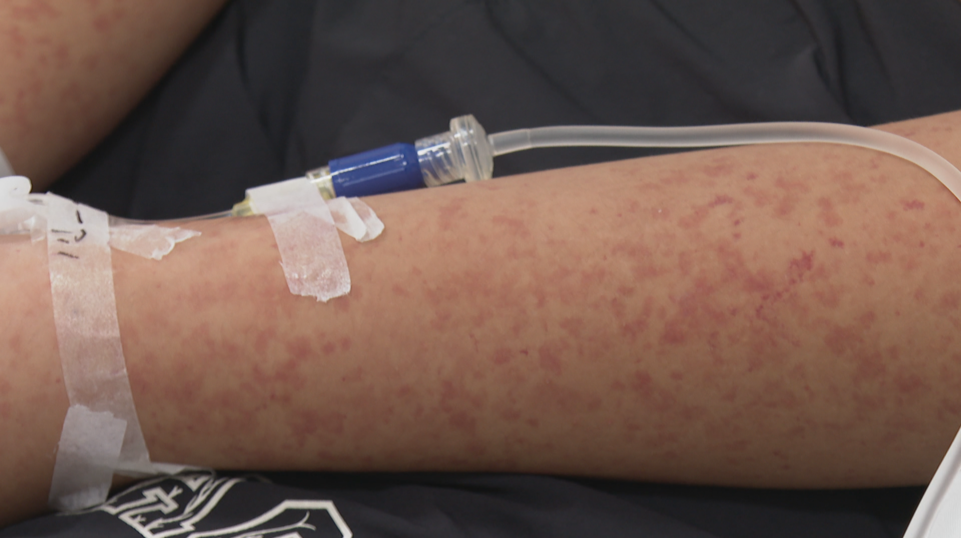 秋冬警惕儿童IgA血管炎 及时就医避免肾损伤