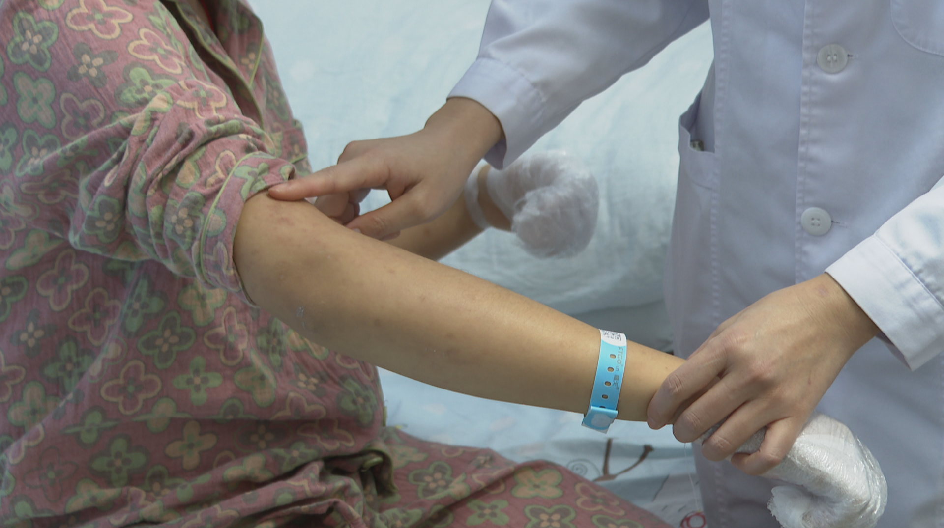 秋冬季节气候干燥  儿童过敏性皮肤病进入高发期