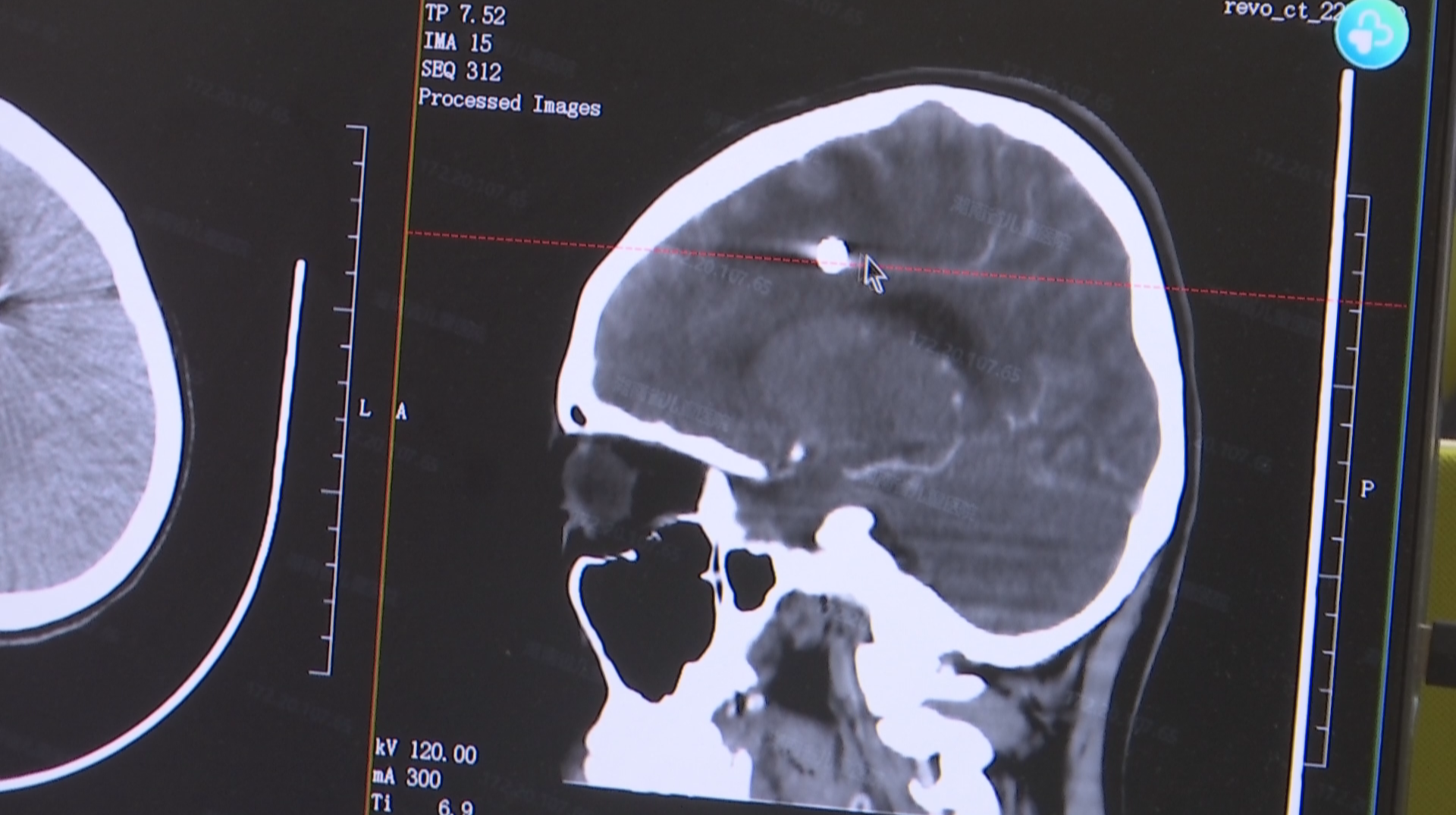 13岁男孩被钢珠穿颅  机器人导航精准拆“弹”
